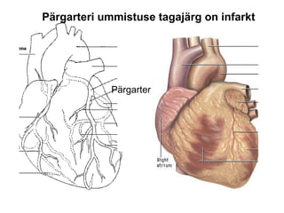 Pärgarteri ummistuse tagajärg on infarkt Pärgarter 