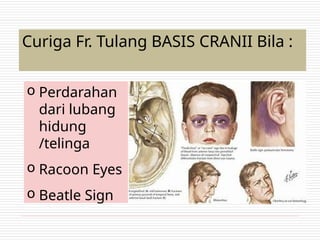 Curiga Fr. Tulang BASIS CRANII Bila :
o Perdarahan
dari lubang
hidung
/telinga
o Racoon Eyes
o Beatle Sign
 