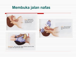 Membuka jalan nafas
 