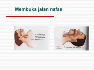 Membuka jalan nafas
 