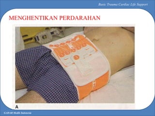 GADAR Medik Indonesia
Basic Trauma Cardiac Life Support
MENGHENTIKAN PERDARAHAN
 