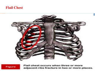 Flail Chest
28
 Flail Chest
 Direct injury to the chest resulting in an
unstable segment of the chest wall that
moves separately from remainder of
thoracic cage
 Typically results from two or more
fractures on 2 or more ribs
 Typically accompanied by a pulmonary
contusion
 Physical exam = paradoxical movement of
chest segment
 Treatment = improve abnormalities in gas
exchange
 Early intubation for patients with
respiratory distress
 Avoidance of overaggressive fluid
resuscitation
 