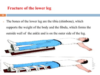 Fracture of the lower leg
2/7/2023
 The bones of the lower leg are the tibia (shinbone), which
supports the weight of the body and the fibula, which forms the
outside wall of the ankle and is on the outer side of the leg.
38
 