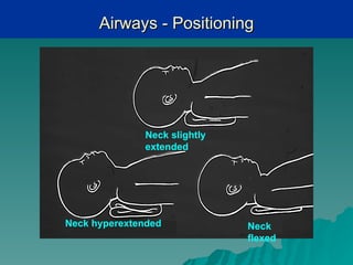 Airways - Positioning




              Neck slightly
              extended




Neck hyperextended            Neck
                              flexed
 