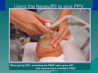 Using the Neopuff® to give PPV




When giving PPV, occluding the PEEP valve gives PIP
                    and uncovering it maintains PEEP.
 
