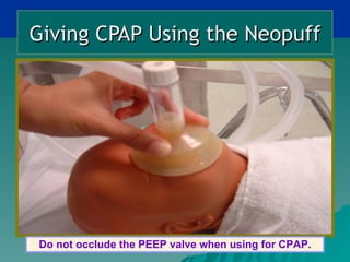Giving CPAP Using the Neopuff




Do not occlude the PEEP valve when using for CPAP.
 