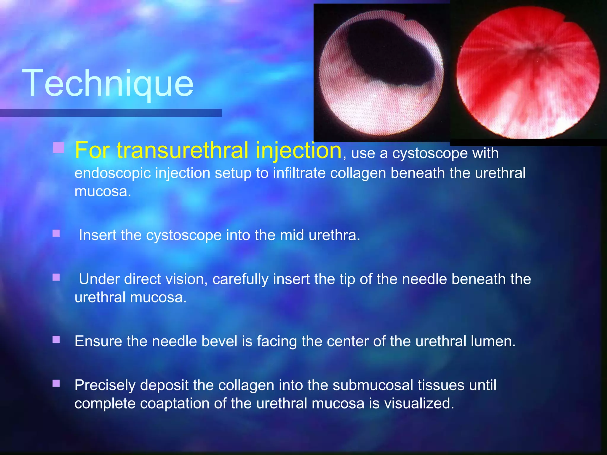 Injectable materials for stress incontinence in males | PPT