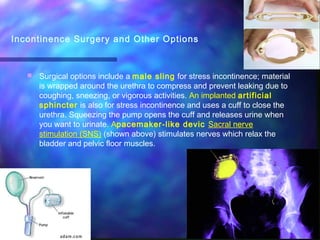 Injectable materials for stress incontinence in males | PPT