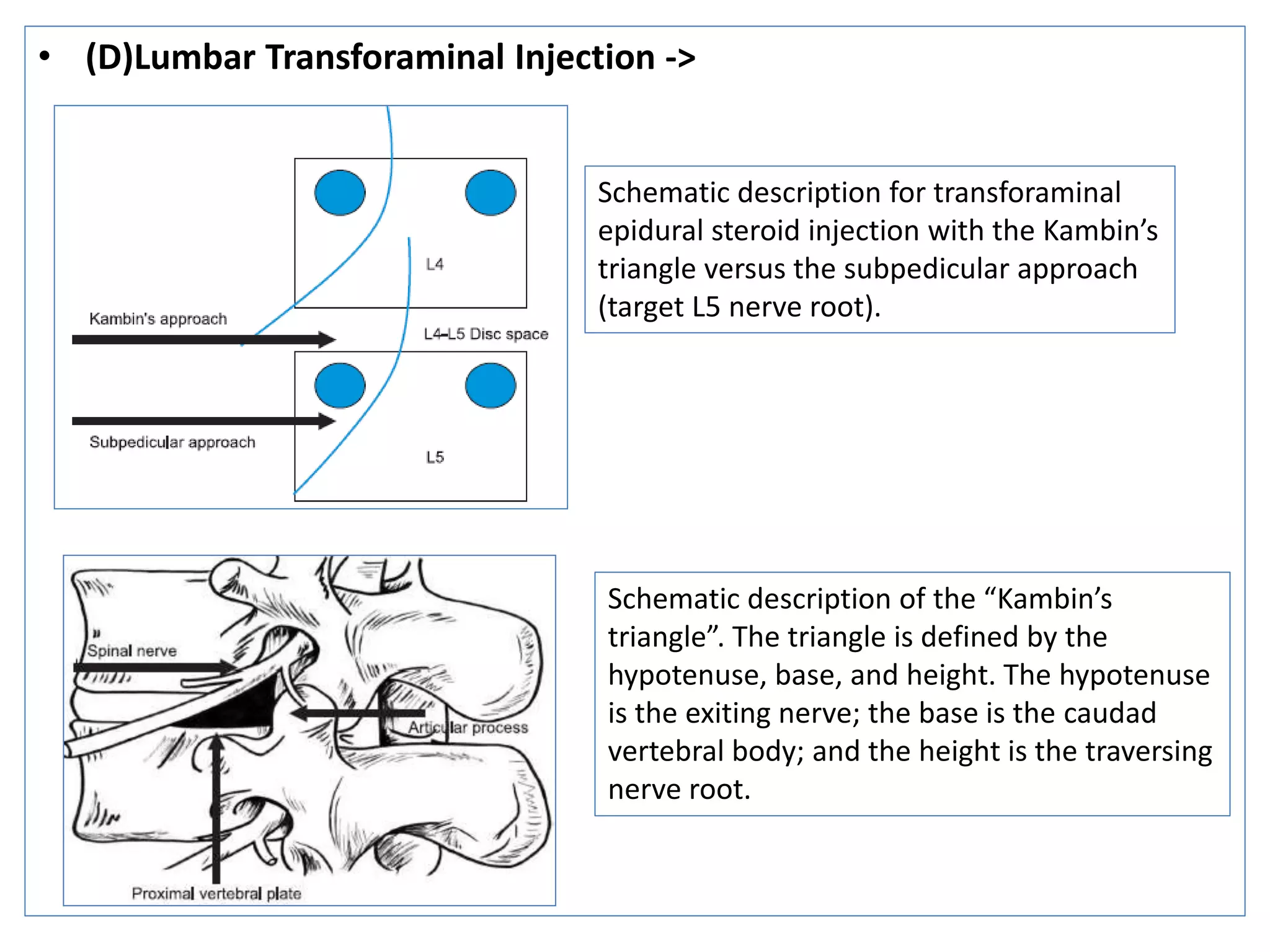 Injection in spine | PPTX