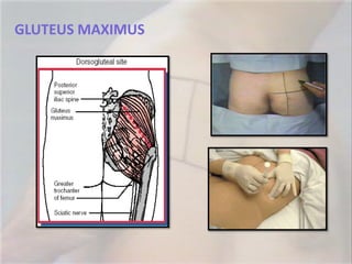 GLUTEUS MAXIMUS
 