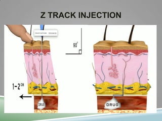 Injected Tracking Device Injection Technique | PPTX