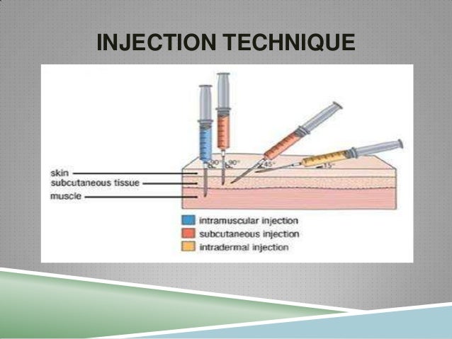 SEARCH AND BUY THIS PRODUCT Injection Technique
