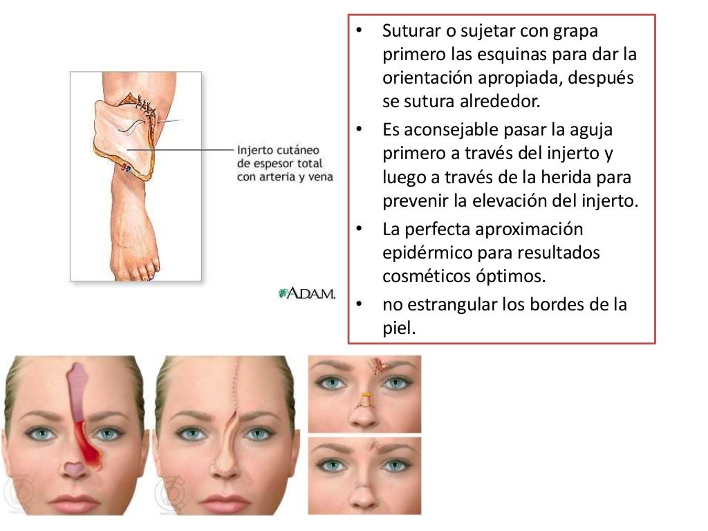 Injerto de piel completo Injerto de piel completo