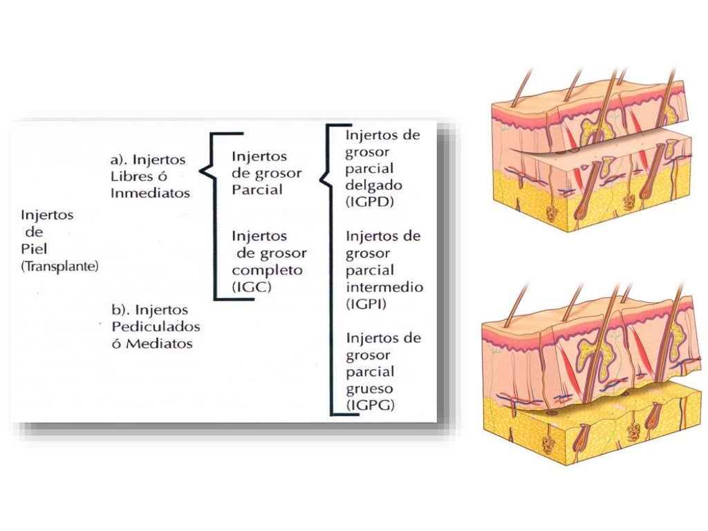 Injerto de piel completo Injerto de piel completo