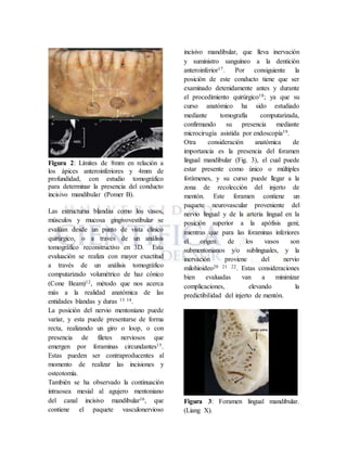 Figura 2: Límites de 8mm en relación a
los ápices anteroinferiores y 4mm de
profundidad, con estudio tomográfico
para determinar la presencia del conducto
incisivo mandibular (Pomer B).
Las estructuras blandas como los vasos,
músculos y mucosa gingivovestibular se
evalúan desde un punto de vista clínico
quirúrgico, o a través de un análisis
tomográfico reconstructivo en 3D. Esta
evaluación se realiza con mayor exactitud
a través de un análisis tomográfico
computarizado volumétrico de haz cónico
(Cone Beam)12, método que nos acerca
más a la realidad anatómica de las
entidades blandas y duras 13 14.
La posición del nervio mentoniano puede
variar, y esta puede presentarse de forma
recta, realizando un giro o loop, o con
presencia de filetes nerviosos que
emergen por foraminas circundantes15.
Estas pueden ser contraproducentes al
momento de realizar las incisiones y
osteotomía.
También se ha observado la continuación
intraosea mesial al agujero mentoniano
del canal incisivo mandibular16, que
contiene el paquete vasculonervioso
incisivo mandibular, que lleva inervación
y suministro sanguíneo a la dentición
anteroinferior17. Por consiguiente la
posición de este conducto tiene que ser
examinado detenidamente antes y durante
el procedimiento quirúrgico18; ya que su
curso anatómico ha sido estudiado
mediante tomografía computarizada,
confirmando su presencia mediante
microcirugía asistida por endoscopía19.
Otra consideración anatómica de
importancia es la presencia del foramen
lingual mandibular (Fig. 3), el cual puede
estar presente como único o múltiples
forámenes, y su curso puede llegar a la
zona de recolección del injerto de
mentón. Este foramen contiene un
paquete neurovascular proveniente del
nervio lingual y de la arteria lingual en la
posición superior a la apófisis geni;
mientras que para las foraminas inferiores
el origen de los vasos son
submentonianos y/o sublinguales, y la
inervación proviene del nervio
milohioideo20 21 22. Estas consideraciones
bien evaluadas van a minimizar
complicaciones, elevando la
predictibilidad del injerto de mentón.
Figura 3: Foramen lingual mandibular.
(Liang X).
 