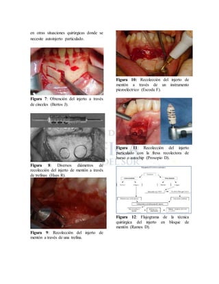 en otras situaciones quirúrgicas donde se
necesite autoinjerto particulado.
Figura 7: Obtención del injerto a través
de cinceles (Bertos J).
Figura 8: Diversos diámetros de
recolección del injerto de mentón a través
de trefinas (Haas R).
Figura 9: Recolección del injerto de
mentón a través de una trefina.
Figura 10: Recolección del injerto de
mentón a través de un instrumento
piezoeléctrico (Escoda F).
Figura 11: Recolección del injerto
particulado con la fresa recolectora de
hueso o autochip (Prosopio D).
Figura 12: Flujograma de la técnica
quirúrgica del injerto en bloque de
mentón (Ramos D).
 