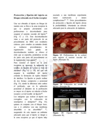 Protección y fijación del injerto en
bloque colocado en el lecho receptor
Una vez obtenido el injerto en bloque de
mentón este se lleva a la zona receptora la
que se prepara previamente con
perforaciones o decorticalizado para
asegurar el sustento vascular del injerto38
(Fig. 12 y 13). Esta decorticalización
viene a ser parte del protocolo de un
procedimiento de RBG con resultados
exitosos, pero estudios en animales donde
se realizaron procedimientos de
regeneración ósea guiada sin
decorticalización también se obtuvo el
éxito que se esperaba, poniéndose en tela
de juicio esta parte del procedimiento en
la regeneración ósea guiada39.
Para sostener el injerto en la zona
receptora es necesario la aplicación de
tornillos de fijación de 1,2mm a 2mm de
diámetro6 (Fig. 12 y 14), los que van
asegurar la estabilidad del injerto
evitando la formación de tejidos blandos
de interface. La fijación se puede realizar
de dos formas: compresiva y posicional
(Fig. 15), siendo la diferencia entre ambas
el perforado, que en la aplicación
posiciónal el diámetro de la perforación
es mayor en el injerto en relación al lecho
receptor y al del tornillo de fijación40.
Los márgenes que rodean al injerto son
corregidos con la colocación de
xenoinjertos o aloinjertos41 (Fig. 16);
quienes en conjunto con el bloque óseo,
van a ir cubiertos con una membrana
absorbible o no absorbible42 43,
asegurando de esta manera un ambiente
adecuado para que el injerto se integre a
la zona receptora ya que el injerto inlay
asociado a una membrana experimenta
menor reabsorción y menos
complicaciones44 45. Estos procedimientos
de protección y fijación del injerto elevan
la predictibilidad, obteniendo un reborde
adecuado para la colocación de implantes.
Figura 13: Perforaciones de la cortical
para mejorar el sustento vascular del
injerto (Prosopio D).
Figura 14: Colocación del tornillo de
fijación (Prosopio D).
Figura 15: Fijación del Tornillo
(Mazoneto R).
 