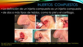 INJERTOS COMPUESTOS
• La definición de un injerto compuesto es un injerto compuesto
• de dos o más tipos de tejidos, como la piel y el cartílago.
Skin graft: Saja S. Scherer-Pietramaggiori, Giorgio Pietramaggiori, and Dennis P. Orgill in Peter C. Neligan. Plastic Surgery. Third Edition.
USA. Elsevier 2013
 