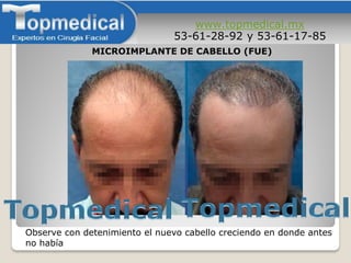 www.topmedical.mx
53-61-28-92 y 53-61-17-85
Observe con detenimiento el nuevo cabello creciendo en donde antes
no había
MICROIMPLANTE DE CABELLO (FUE)
 