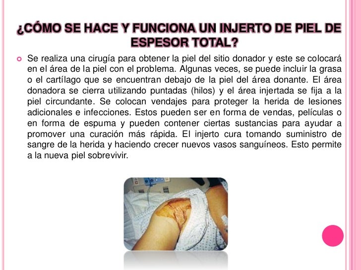 Injertos de piel Injertos de piel