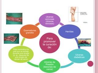 Para
promover
la curación
de:
Ulceras
varicosas
(úlceras
venosas)
Heridas
Ulceras
diabéticas
Ulceras de
Presión
(lesiones de
cama)
Para reconstruir la
piel que se extrajo
durante una cirugía
(p. ej., después de
una cirugía de
cáncer de seno)
Quemaduras
grandes
 
