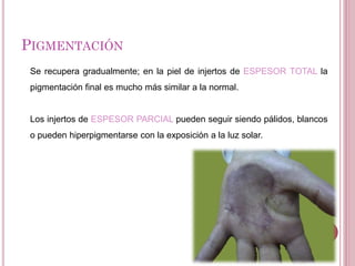 Se recupera gradualmente; en la piel de injertos de ESPESOR TOTAL la
pigmentación final es mucho más similar a la normal.
Los injertos de ESPESOR PARCIAL pueden seguir siendo pálidos, blancos
o pueden hiperpigmentarse con la exposición a la luz solar.
PIGMENTACIÓN
 