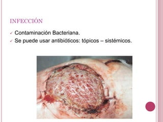 INFECCIÓN
 Contaminación Bacteriana.
 Se puede usar antibióticos: tópicos – sistémicos.
 