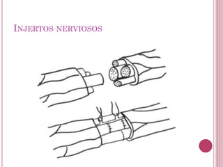 INJERTOS NERVIOSOS
 