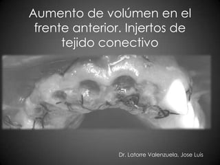 Aumento de volúmen en el
 frente anterior. Injertos de
      tejido conectivo




                Dr. Latorre Valenzuela, Jose Luis
 