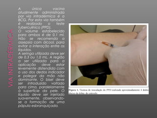 A
única
vacina
atualmente administrada
por via intradérmica é a
BCG. Por esta via também
é
realizado
o
teste
tuberculínico (PPD).
O volume estabelecido
para ambos é de 0,1 ml.
Não se recomenda a
assepsia com álcool, para
evitar a interação entre os
líquidos.
A seringa utilizada deve ser
de 0,3 ou 1,0 mL. A região
a ser utilizada para a
aplicação
deve
estar
levemente distendida com
o uso dos dedos indicador
e polegar da mão não
dominante. O bisel deve
ser introduzido voltado
para cima, paralelamente
à superfície da pele. O
líquido deve ser injetado
suavemente, observandose a formação de uma
pápula esbranquiçada.

 