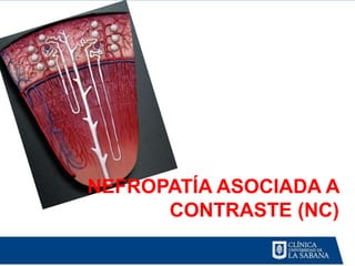 NEFROPATÍA ASOCIADA A
      CONTRASTE (NC)
 