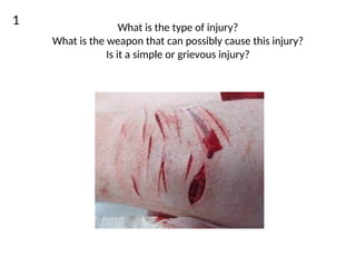 INJURIES IN FORENSIC MEDICINE 1 (1).pptx