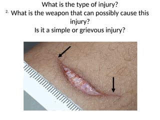 Subtle Injury. Examples INJURIES IN FORENSIC MEDICINE 1 (1).pptx