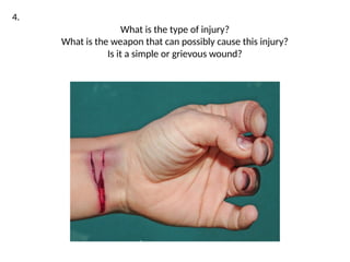 INJURIES IN FORENSIC MEDICINE 1 (1).pptx