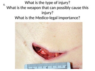 INJURIES IN FORENSIC MEDICINE 1 (1).pptx