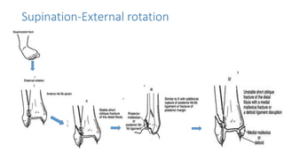 Supinated External Rotation Injuries around ankle presentation by Dr. Shiva Prasad | PPTX