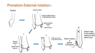 Pronation Internal Rotation Injuries around ankle presentation by Dr. Shiva Prasad | PPTX
