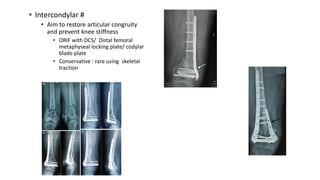 • Intercondylar #
• Aim to restore articular congruity
and prevent knee stiffness
• ORIF with DCS/ Distal femoral
metaphyseal locking plate/ codylar
blade plate
• Conservative : rare using skeletal
traction
 