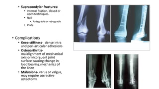• Supracondylar fractures:
• Internal fixation. closed or
open techniques.
• Nail
• Antegrade or retrograde
• Plate
• Complications
• Knee stiffness- dense intra
and peri-articular adhesions
• Osteoarthritis-
malalignment of mechanical
axis or incorguent joint
surface causing change in
load bearing mechanics of
the knee
• Malunions- varus or valgus,
may require corrective
osteotomy
 