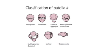 Classification of patella #
 