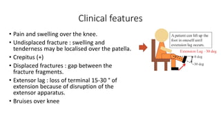 Clinical features
• Pain and swelling over the knee.
• Undisplaced fracture : swelling and
tenderness may be localised over the patella.
• Crepitus (+)
• Displaced fractures : gap between the
fracture fragments.
• Extensor lag : loss of terminal 15-30 ° of
extension because of disruption of the
extensor apparatus.
• Bruises over knee
 