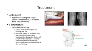 Treatment
• Undisplaced
• Cylindrical cast (groin to just
above the malleolus) x 3 weeks
then physiotherapy
• 2 part fracture
• Tension band wiring:
• Allows early mobilization and
healing at # site
• Principle: when an eccentric load
is applied to tension band
construct the distractive forces (of
patella and quadriceps tendon)
are converted to compressive
forces leading to compression at #
site and healing
 