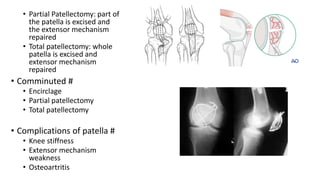 • Partial Patellectomy: part of
the patella is excised and
the extensor mechanism
repaired
• Total patellectomy: whole
patella is excised and
extensor mechanism
repaired
• Comminuted #
• Encirclage
• Partial patellectomy
• Total patellectomy
• Complications of patella #
• Knee stiffness
• Extensor mechanism
weakness
• Osteoartritis
 