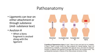 Pathoanatomy
• Ligaments can tear on
either attachment or
through substance
(mid- substance tear)
• Avulsion #
• When a bony
fragment is avulsed
along with the
ligament
 