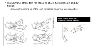 • Valgus/Varus stress test for MCL and LCL in full extension and 30°
flexion
• Abnormal “opening up of the joint compared to normal side is positive)
 