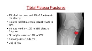Tibial Plateau Fractures
• 1% of all fractures and 8% of fractures in
the elderly.
• Isolated lateral plateau account = 55% to
70%
• Isolated medial= 10% to 25% plateau
fractures
• Bicondylar lesions= 10% to 30%
• Open injuries= 1% to 3%
• Due to RTA
 