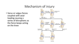 Mechanism of injury
• Varus or valgus forces
coupled with axial
loading causing a
series of disruptions as
the force keeps acting
on the knee
 
