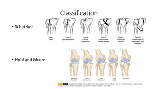 Classification
• Schatzker
• Hohl and Moore
 