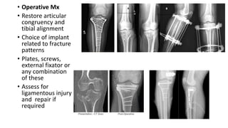• Operative Mx
• Restore articular
congruency and
tibial alignment
• Choice of implant
related to fracture
patterns
• Plates, screws,
external fixator or
any combination
of these
• Assess for
ligamentous injury
and repair if
required
 