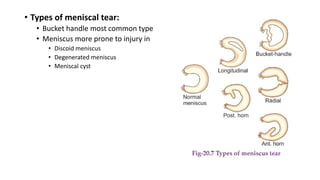 • Types of meniscal tear:
• Bucket handle most common type
• Meniscus more prone to injury in
• Discoid meniscus
• Degenerated meniscus
• Meniscal cyst
 